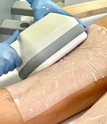 kriolipoliza cooltech